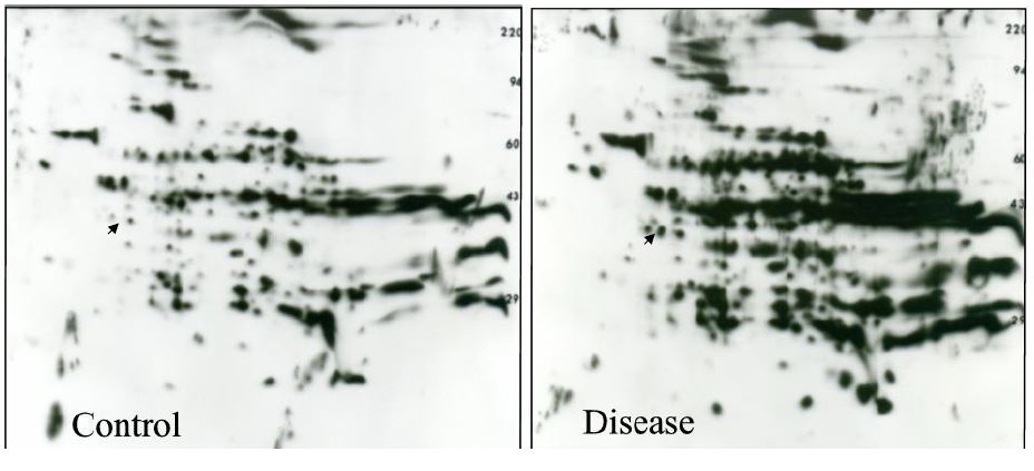 2D western blot anti-acetyl lysine ab: lysine acetylation increases in diseased vs. control liver 