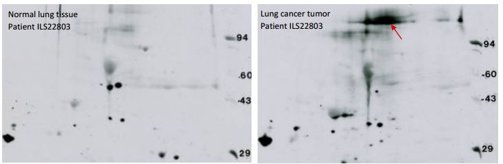 Anti- phosphotyrosine 2D gel Western blot: Lung (normal or tumor), standard format gel